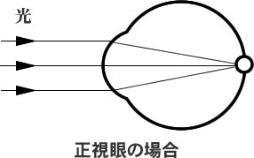 正視眼とは