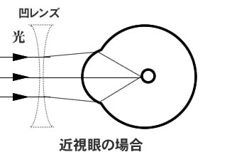近視眼とは