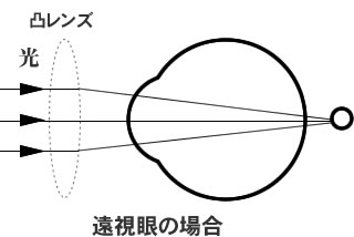 遠視眼とは